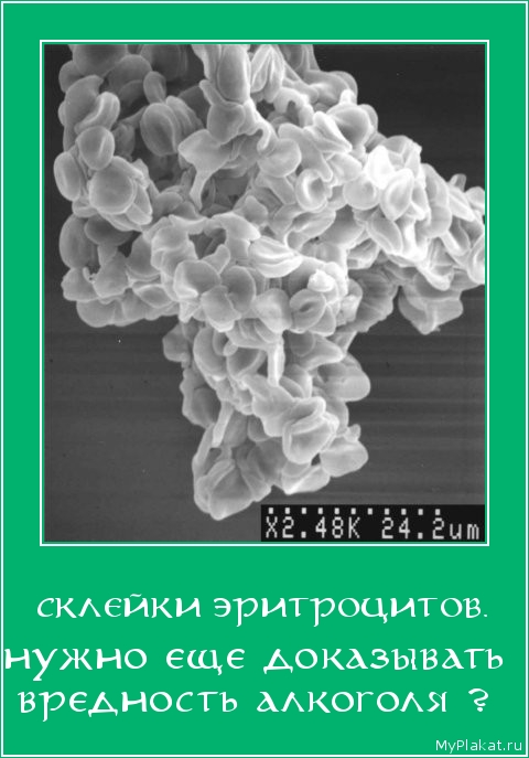 СКЛЕЙКИ ЭРИТРОЦИТОВ. нужно еще доказывать вредность алкоголя ?
